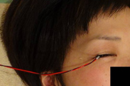 経角膜電気刺激治療の様子
