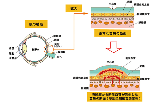 非加齢性黄斑変性症の治療